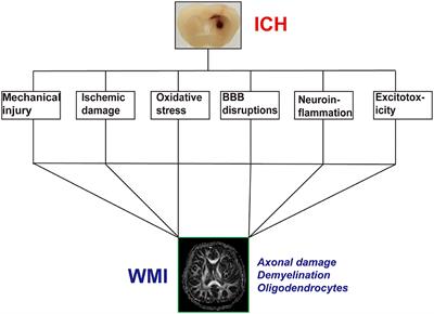 White Matter Injury After Intracerebral Hemorrhage